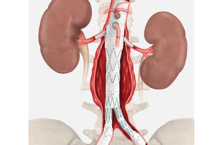Cook Medical completes patient enrollment in pivotal study for Zenith Fenestrated+ endovascular graft