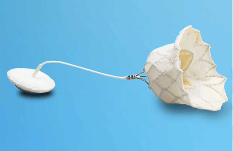 Abbott achieves first U.S. commercial implant of Tendyne transcatheter mitral valve replacement system